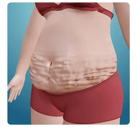 Belly Patches - (5 Pcs)